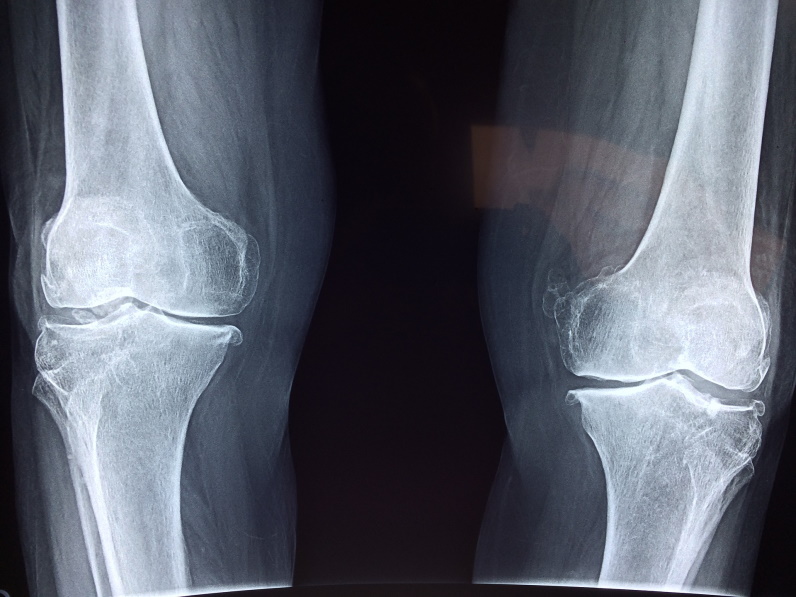 x-ray of knee bones